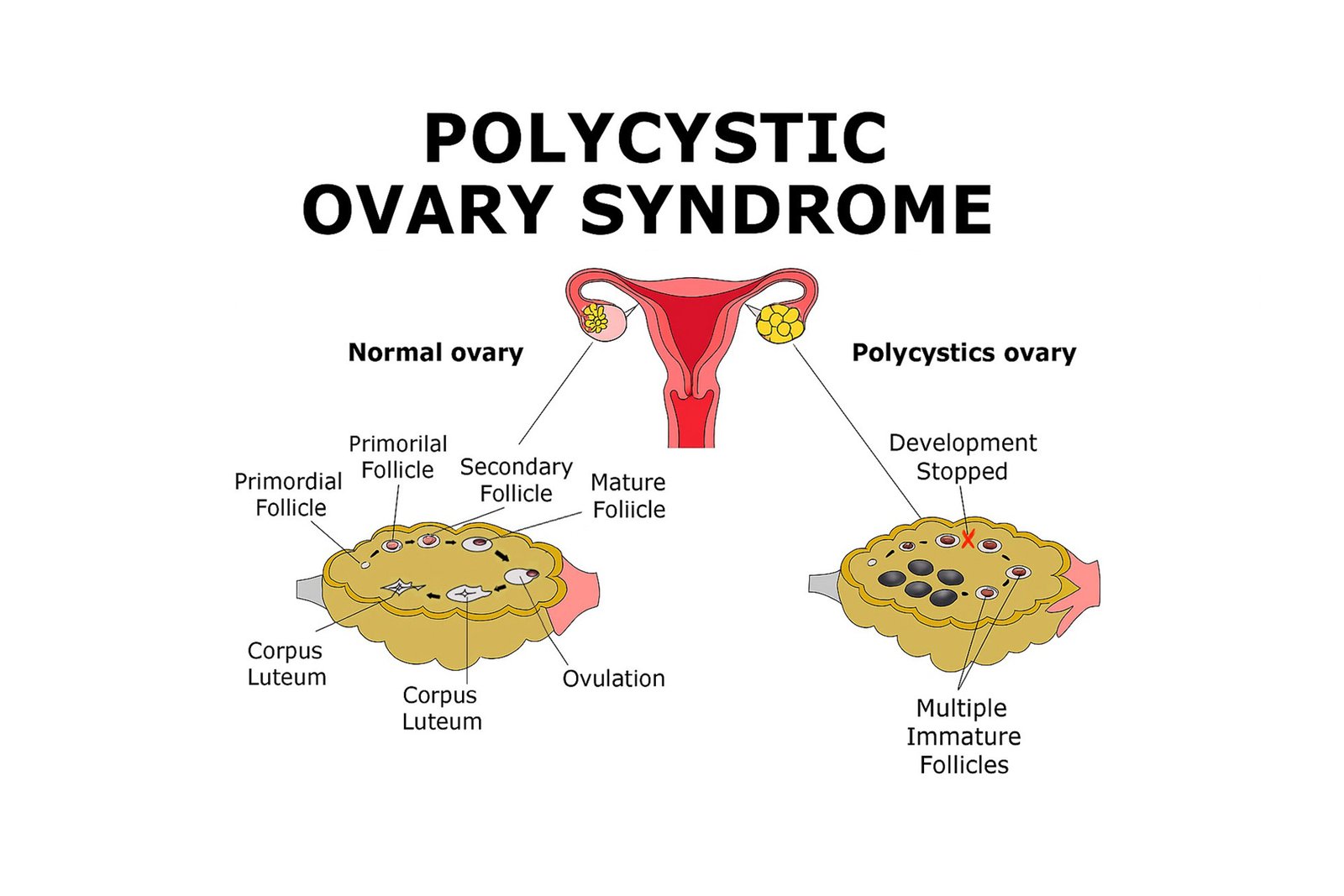 Polycystic Ovary Syndrome (PCOS)