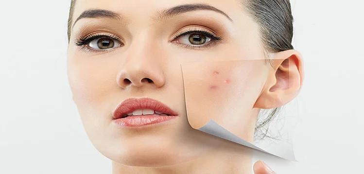 Did You Know That Acne Can Affect Your Mood and Even Lifestyle?