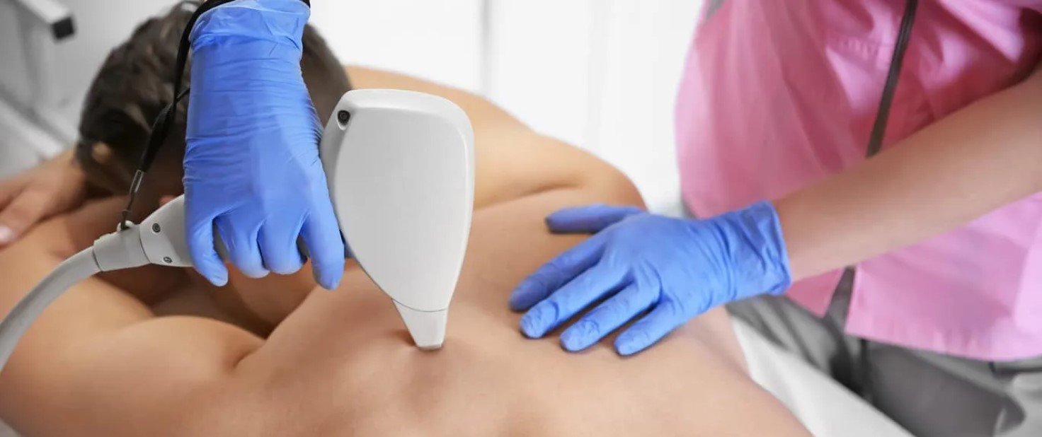 Back Laser Hair Removal