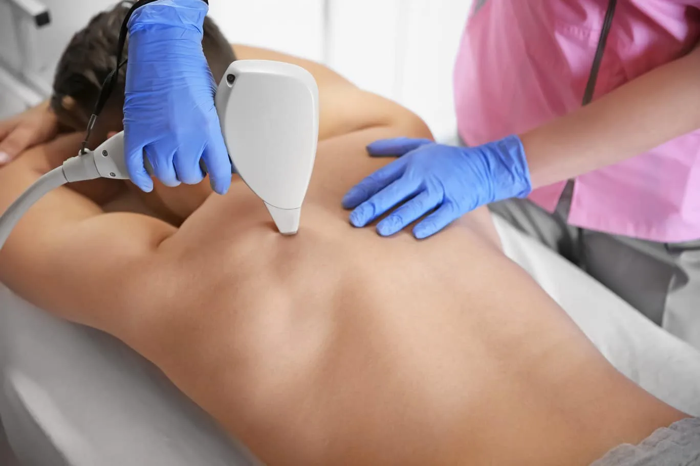 Back Laser Hair Removal