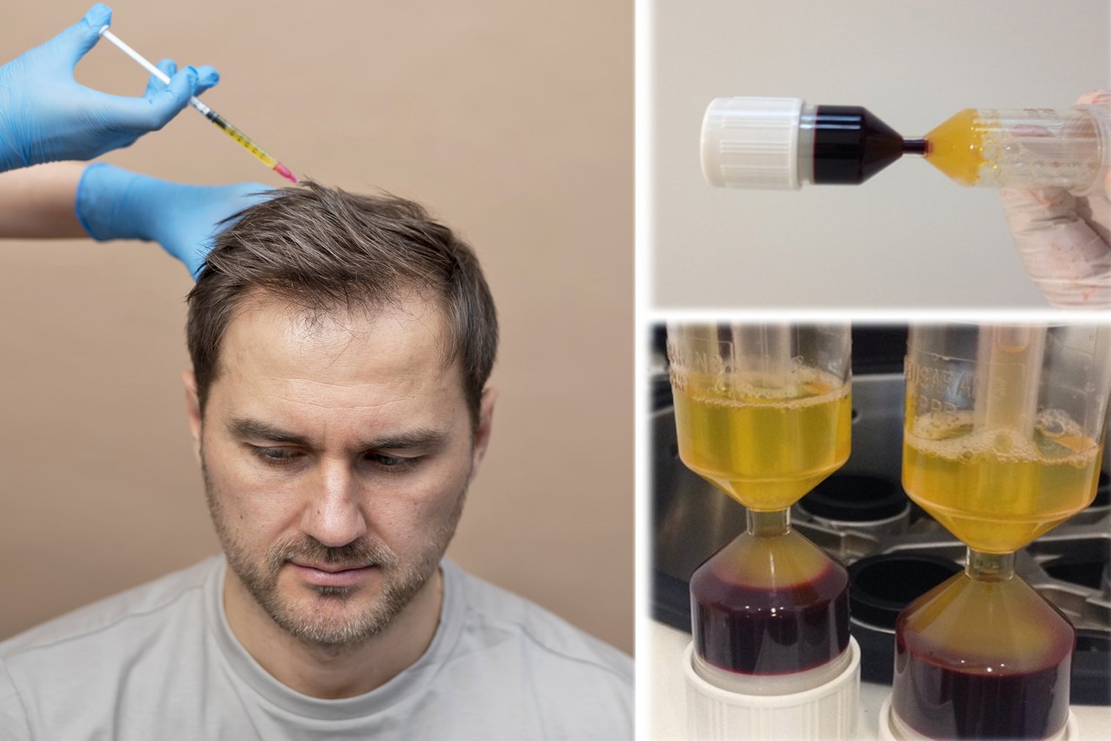 Platelet-Rich Plasma (PRP) treatment