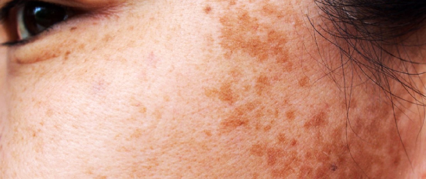 age spots liver spots skin