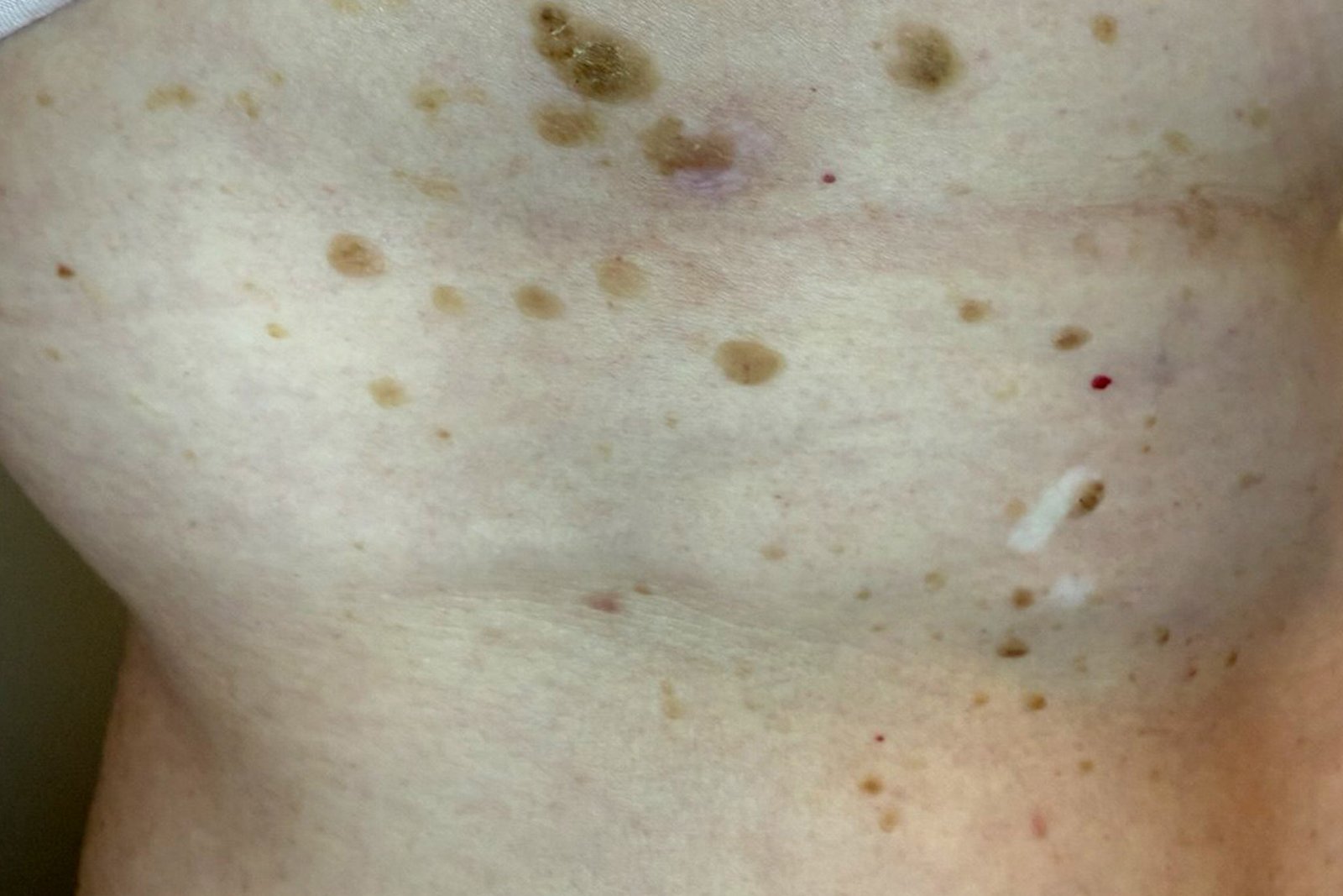 age spots liver spots skin on the side of body at Body Silk Clinic London