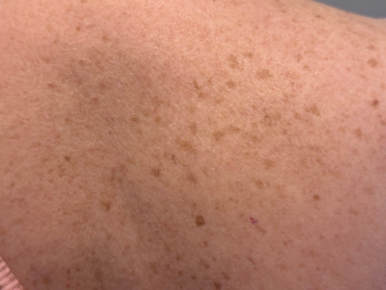 age spots liver spots on the back