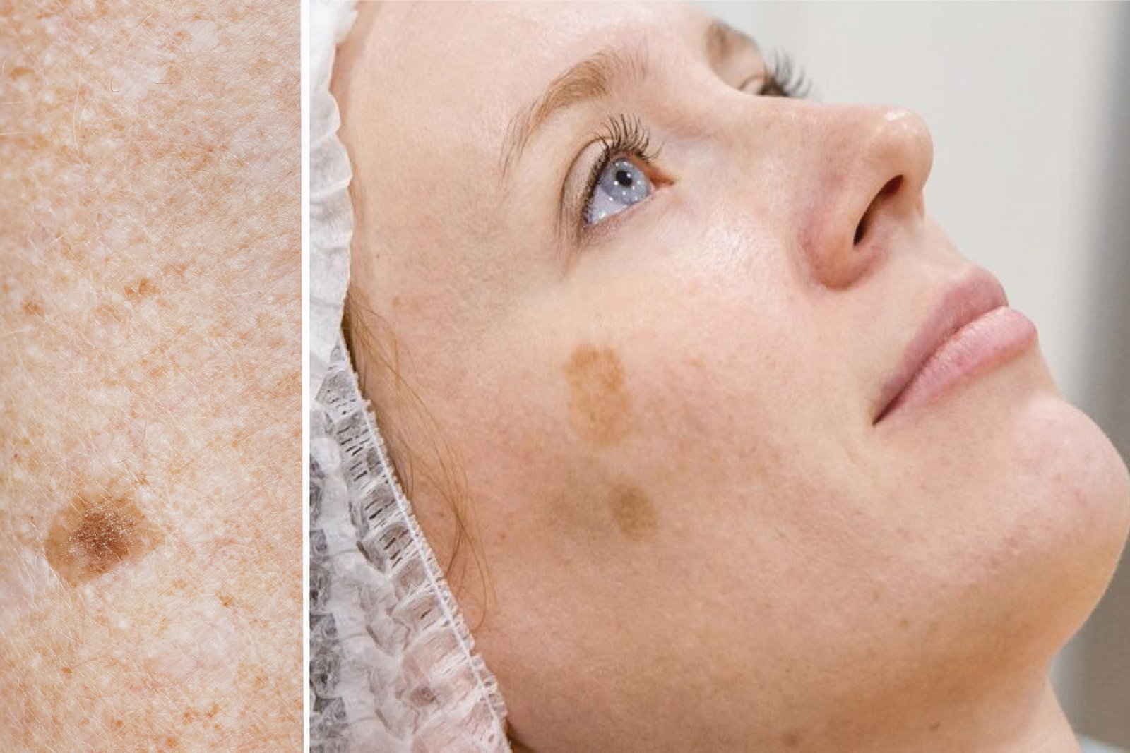 age spots liver spots on the womens face