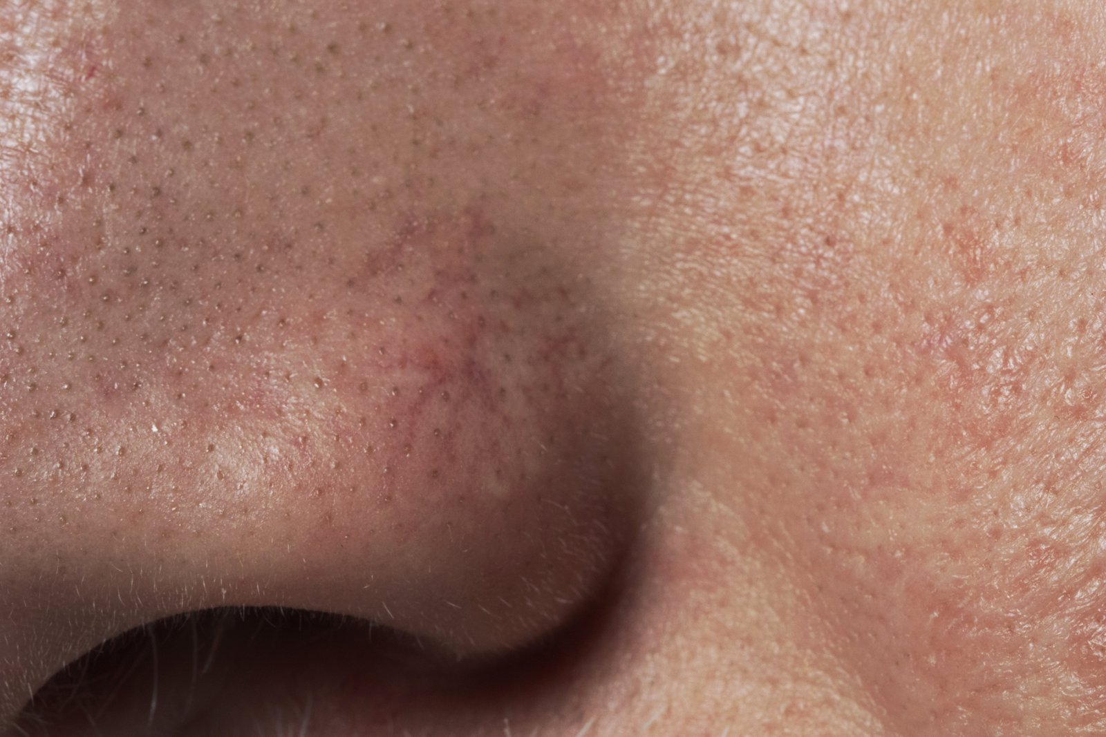 How to get rid of blackheads and whiteheads