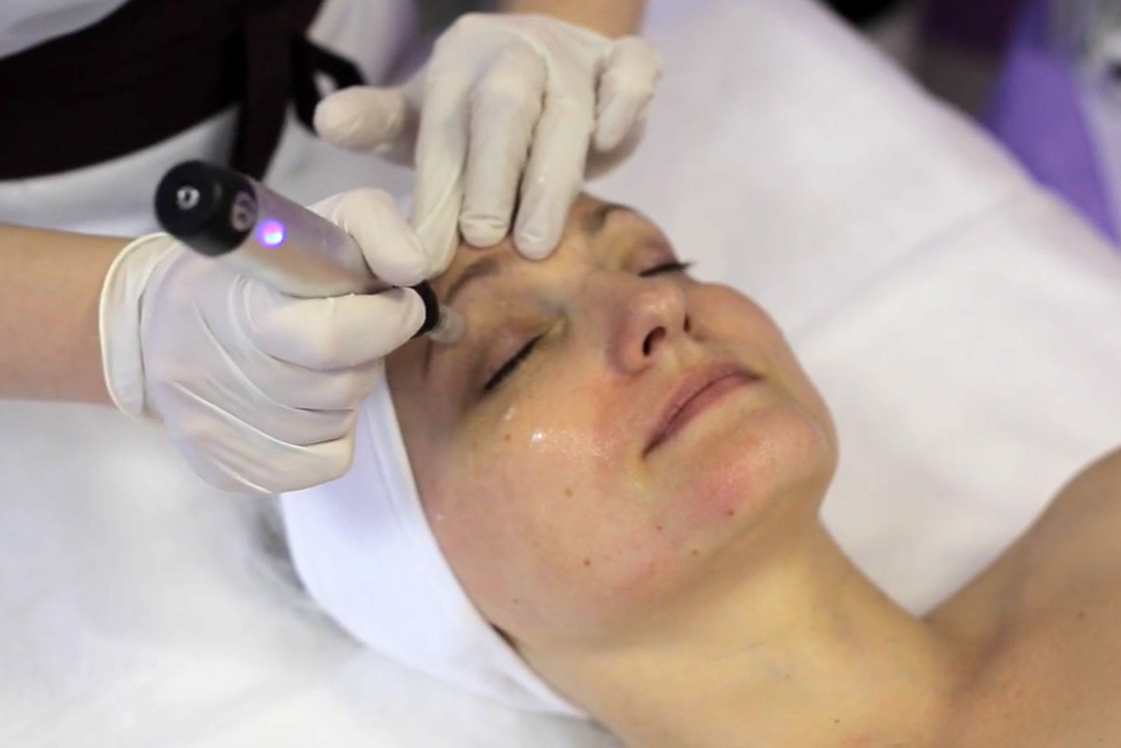 dermapen microneedling above eyes at clinic