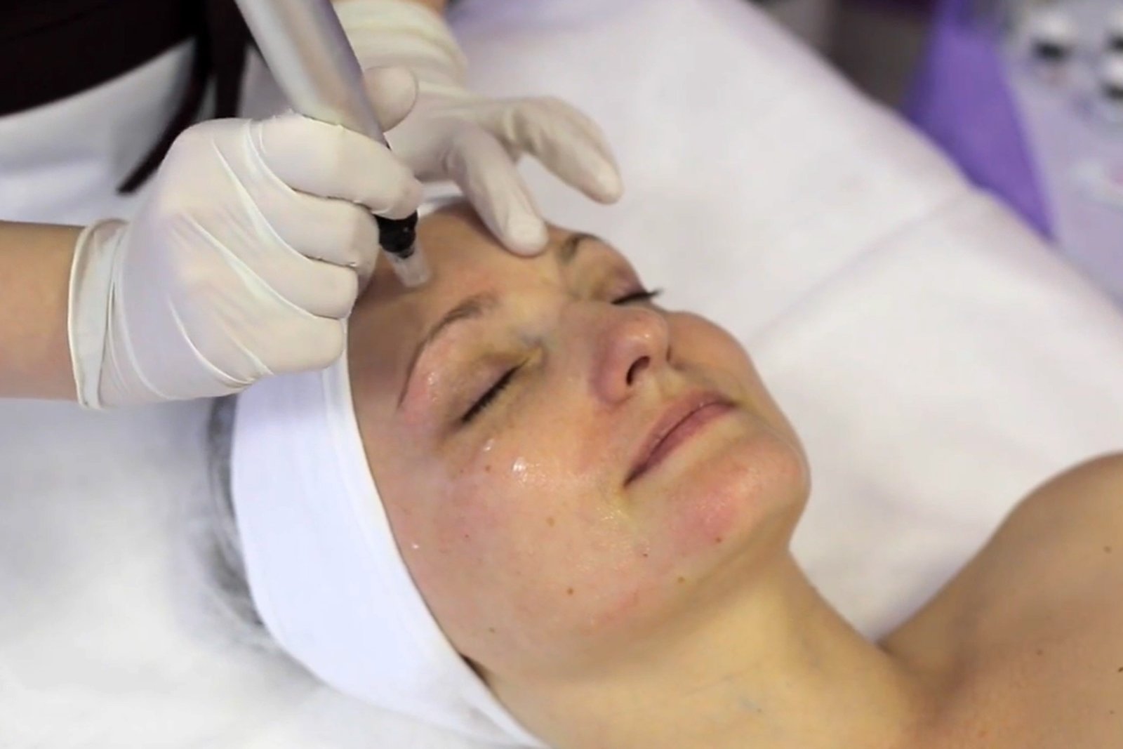 dermapen microneedling at clinic