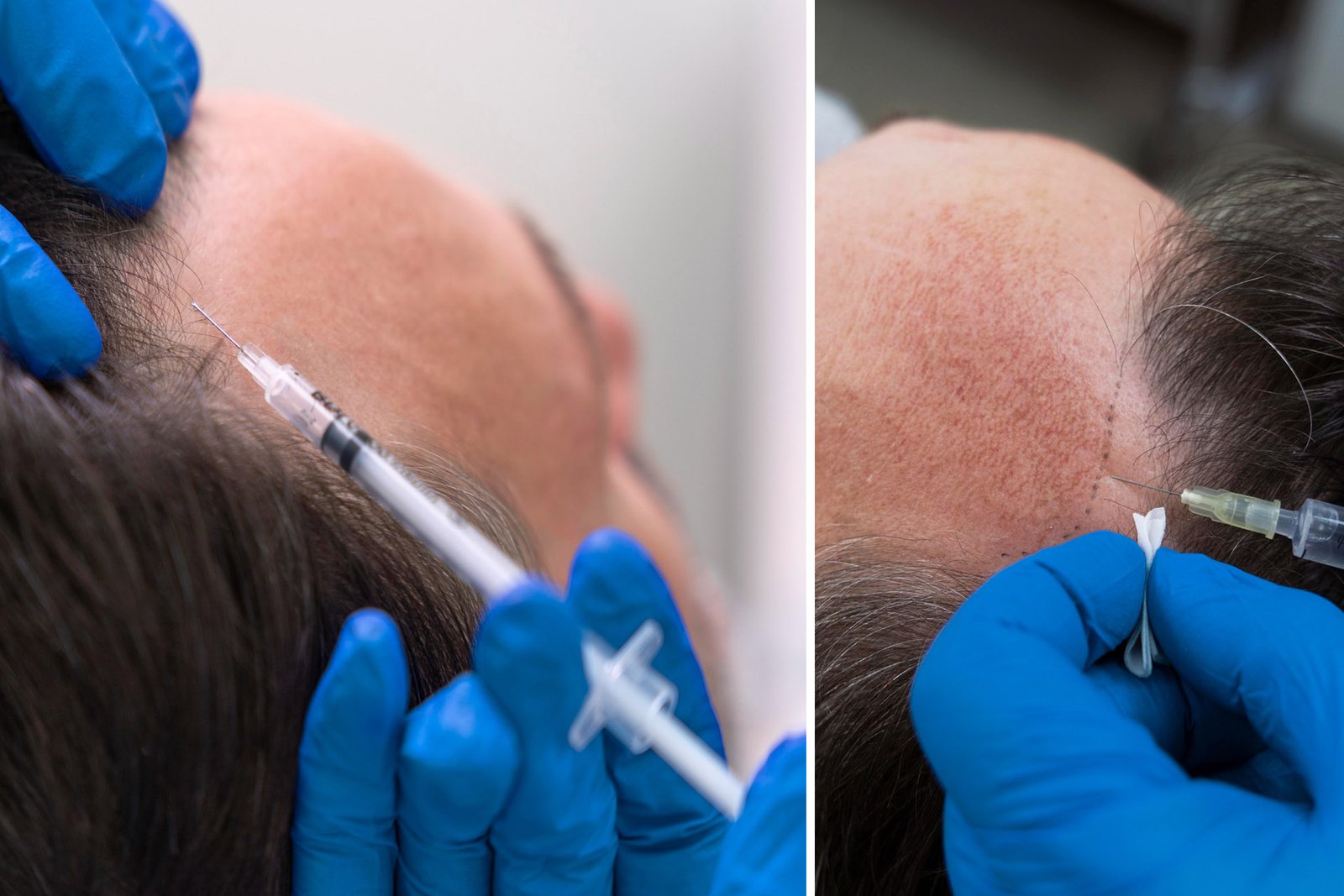 mesotherapy for mens hair