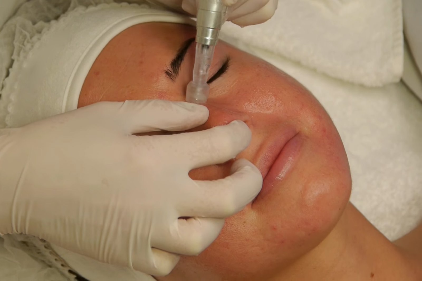 dermapen microneedling treatment for face