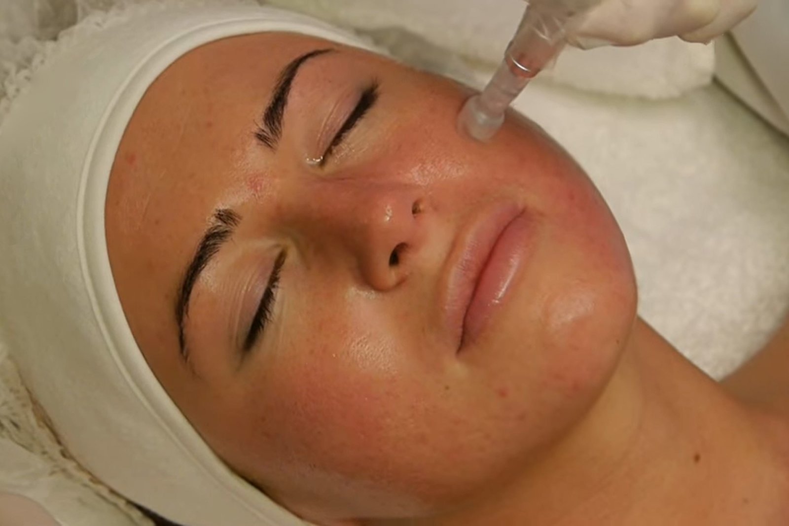 microneedling dermapen facial