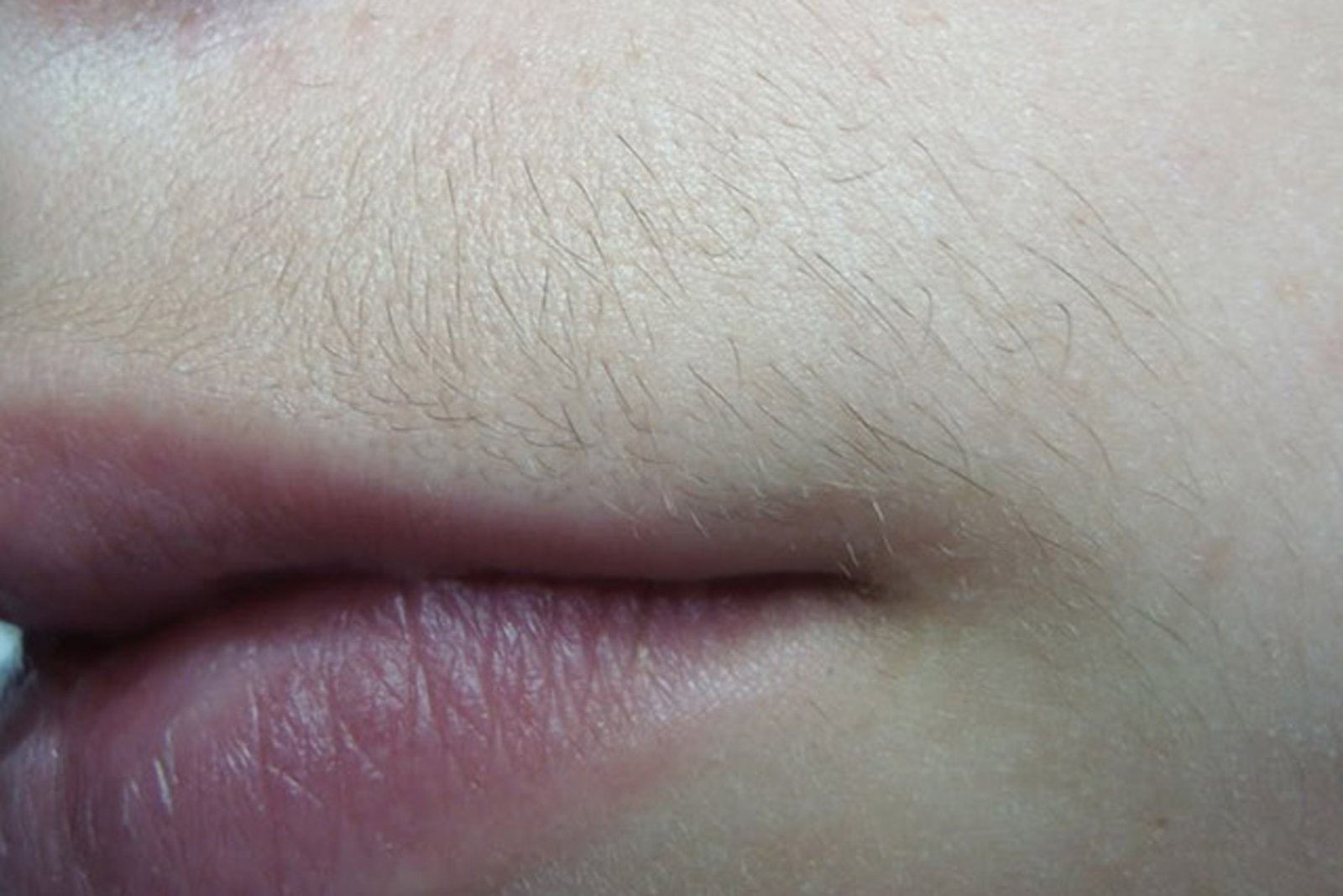 laser hair removal for ladies' upper lips