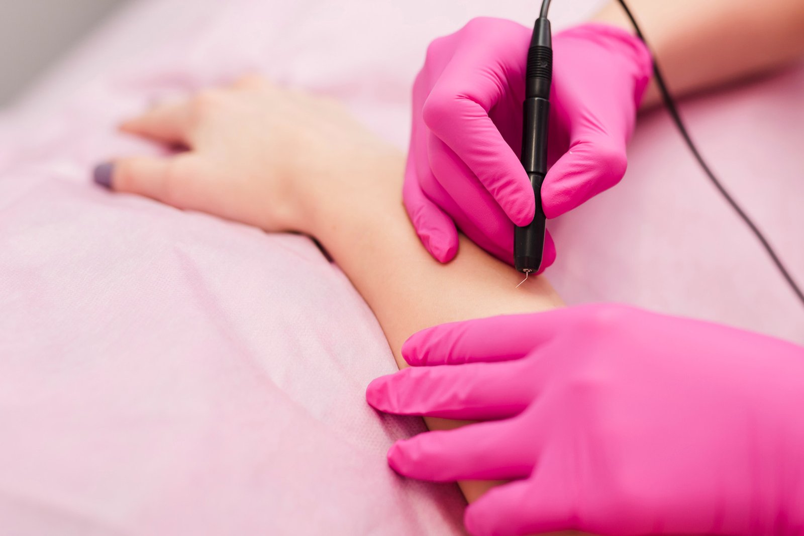 electrolysis for arm