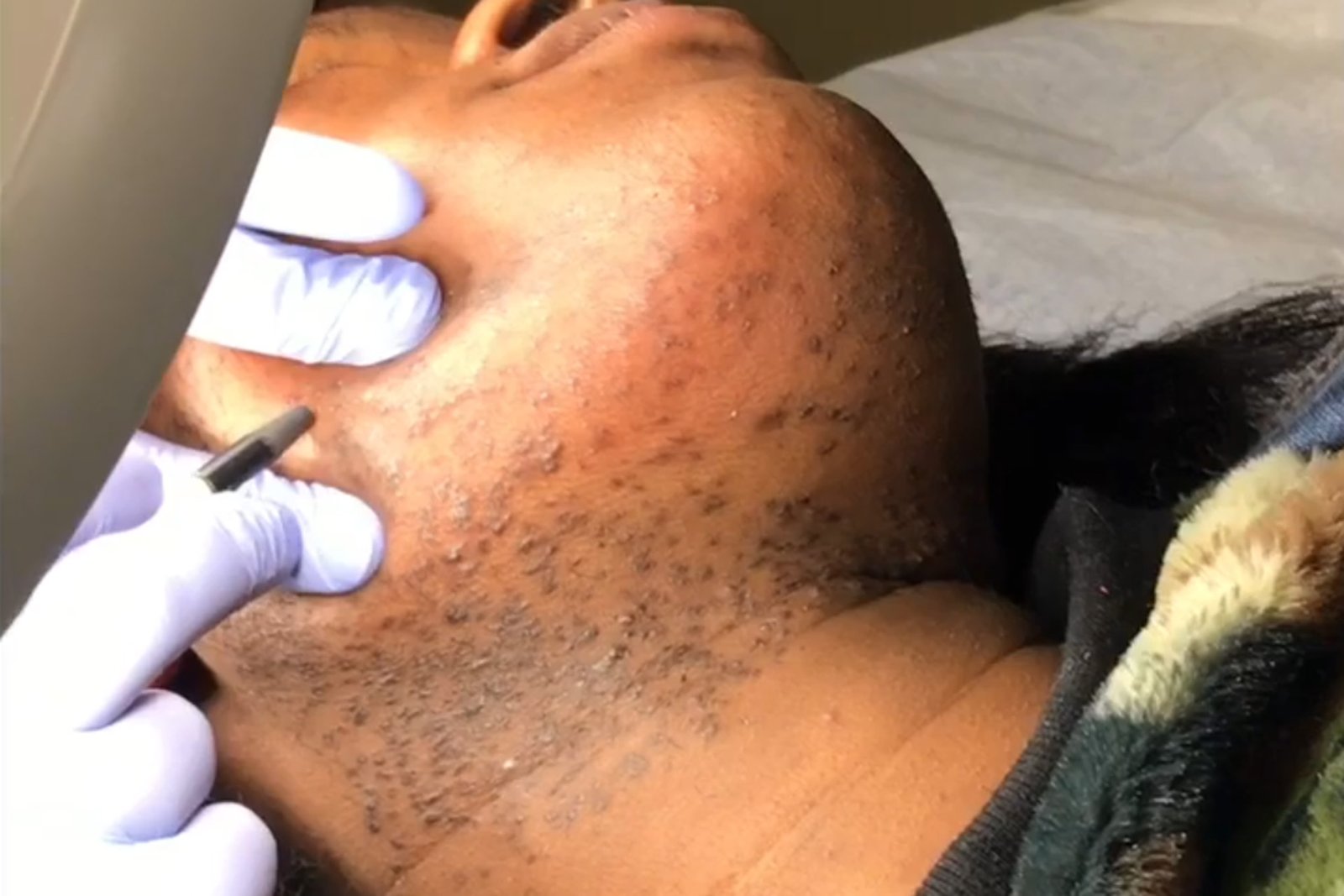 electrolysis for dark skin