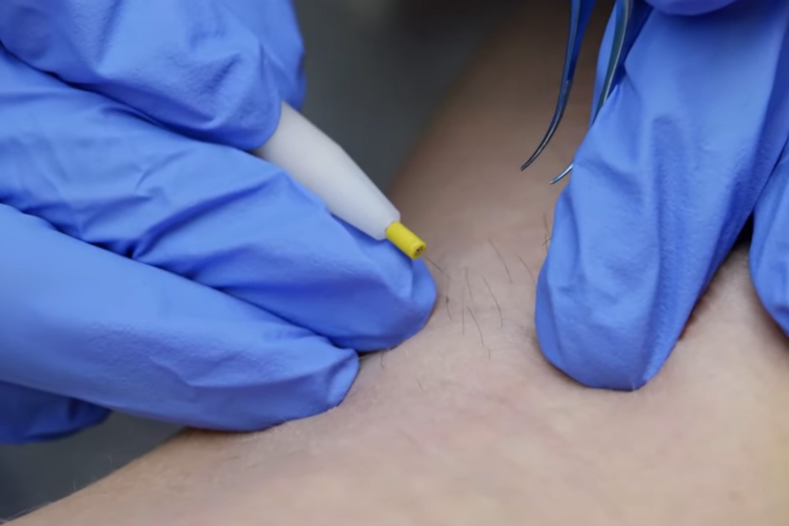 electrolysis treatment