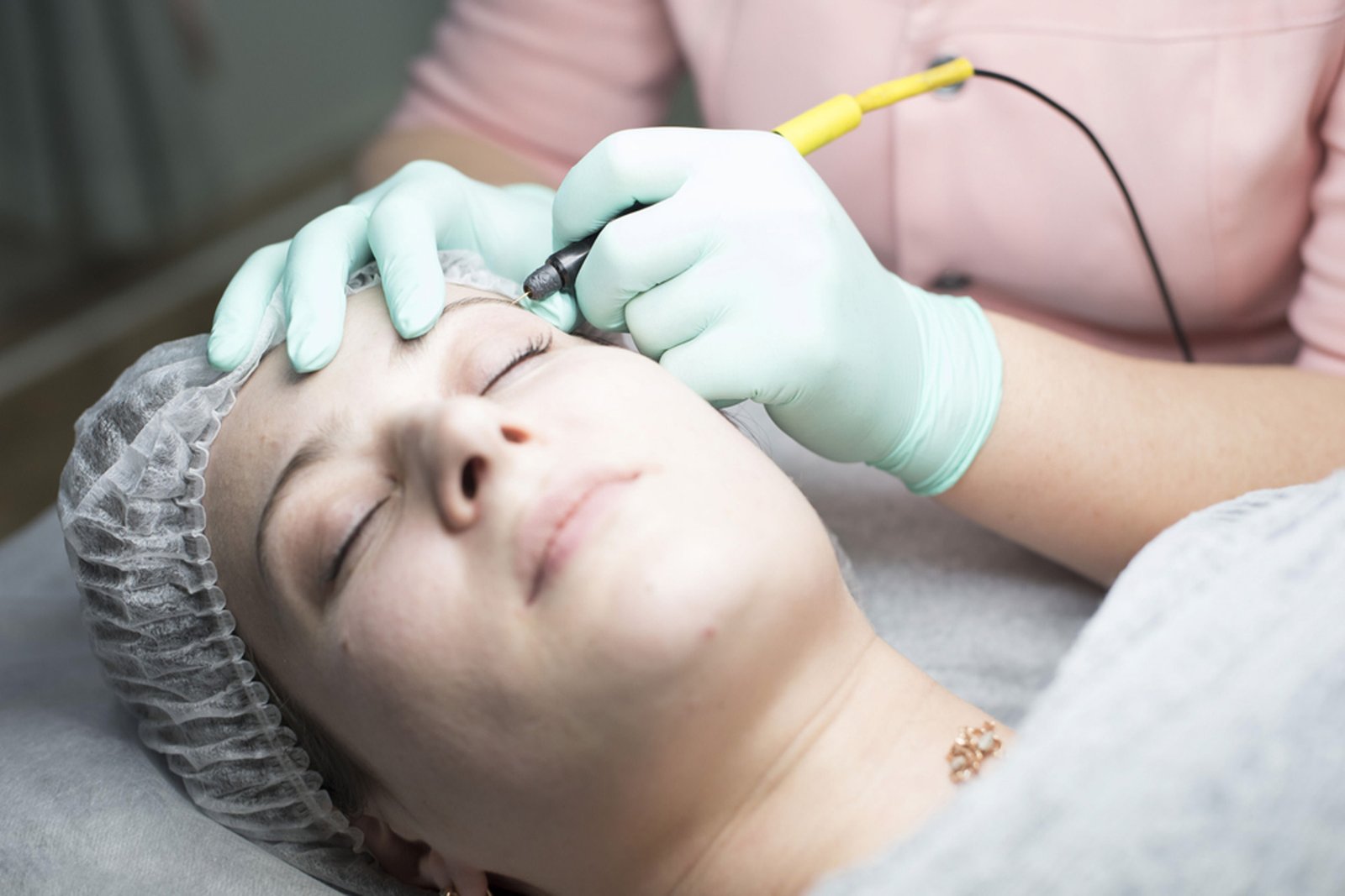 electrolysis for face