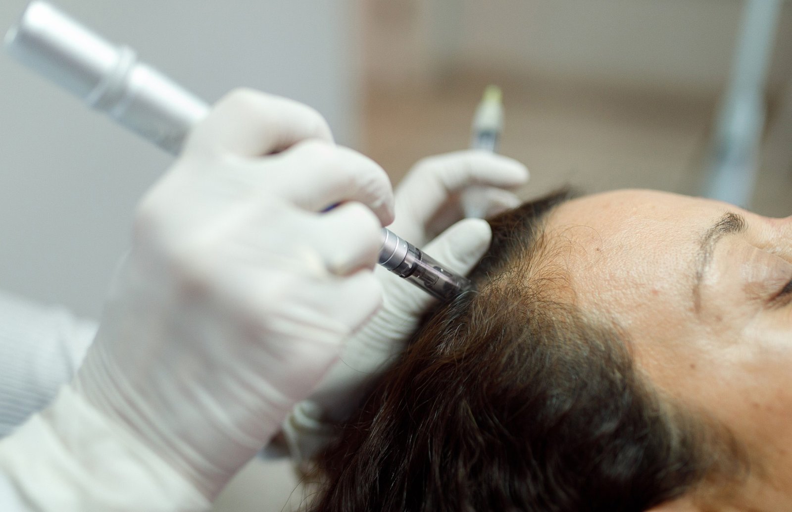 microneedling for hair loss